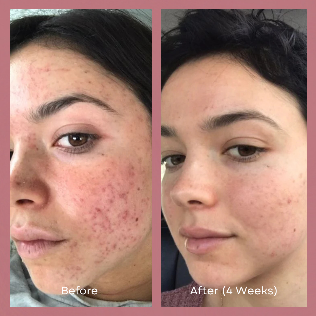 Mascarilla facial LED para una piel radiante